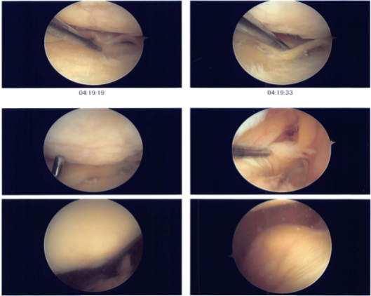 Intraoperative photo