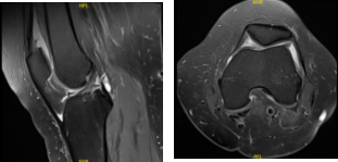 MRI Left knee non-contrast