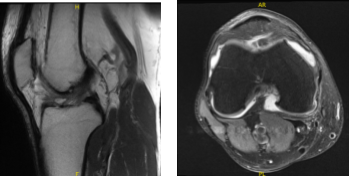 MRI-3T Right knee non-contrast