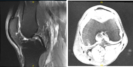 MRI-3T Left knee non-contrast