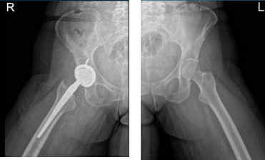 Hip Bilateral with pelvis 3 or 4 more view