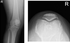 MRI-3T right knee non-contrast