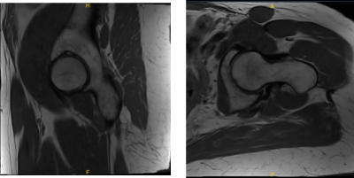 MRI Left hip non-contrast