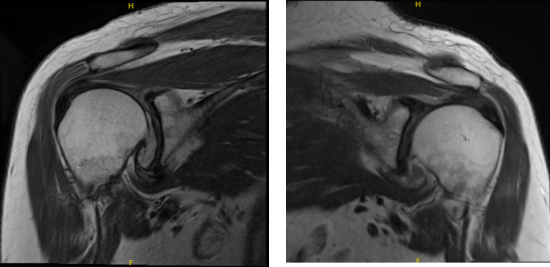 MRI of Left and Right Shoulder