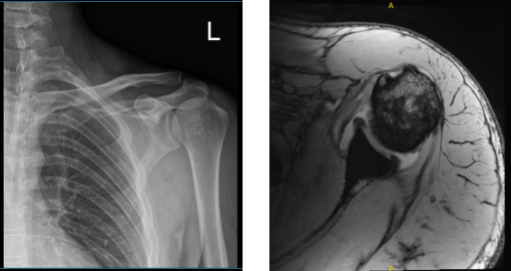 MRI of the biceps