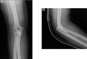 Right elbow x-ray