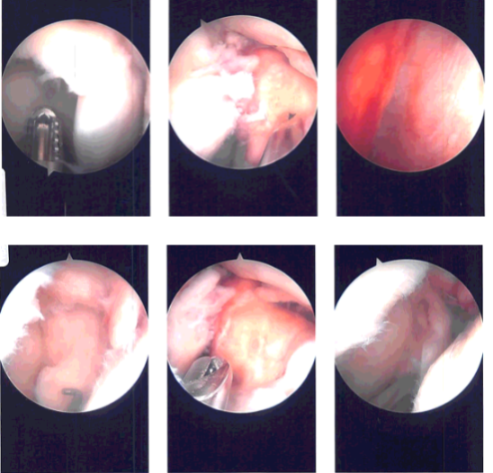 Intraoperative Arthroscopy Images