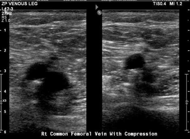 Doppler Venous Lower Extremity Bilateral