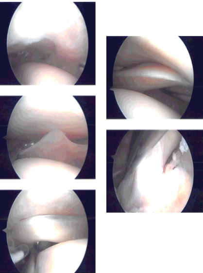 Intraoperative Arthroscopy Images