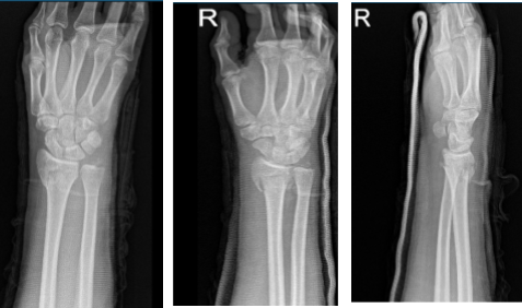 MRI of the wrist