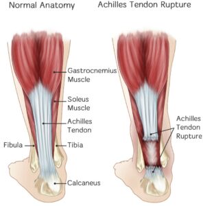 Ruptured Achilles tendon