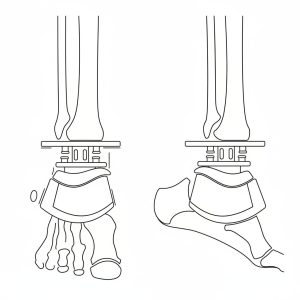 Ankle Osteoarthritis 2